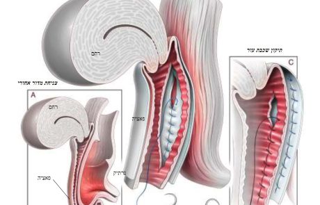 דף מידע בנושא תיקון דופן הנרתיק האחורית והפרינאום