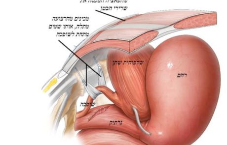 דף מידע תיקון אי נקיטת שתן במאמץ בגישה משולבת בטנית ונרתיקית תוך שימוש בשתל עצמי