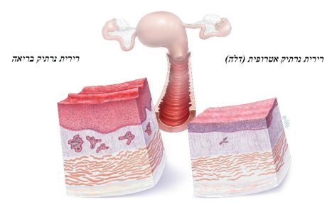 דף מידע בנושא טיפול נרתיקי באסטרוגן