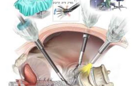 דף מידע בנושא ניתוח לתיקון צניחת אברי האגן בגישה רובוטית