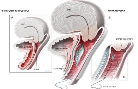 דף מידע בנושא ניתוח מתלה לתיקון דליפת שתן במאמץ