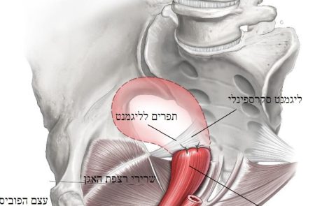 דף מידע בנושא קיבוע סקרוספינאלי