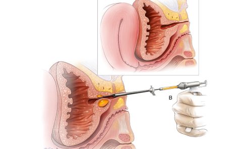 urethral-bulking- דף מידע בנושא עיבוי סביבת השופכה לטיפול בדליפת שתן במאמץ