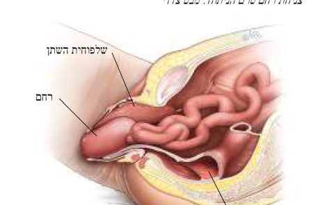 דף מידע בנושא ניתוח לסגירת הנרתיק-קולפוקליזיס