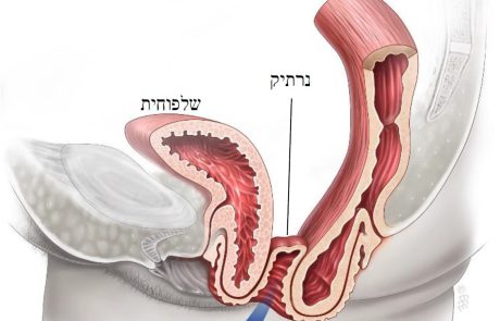 דף מידע בנושא ניתוח סקרל קולפופקסי