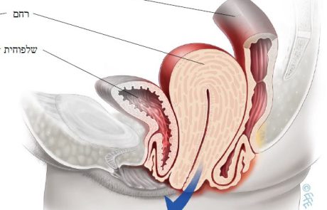 דף מידע בנושא ניתוח לכריתת רחם בגישה לדנית בשל צניחת רחם